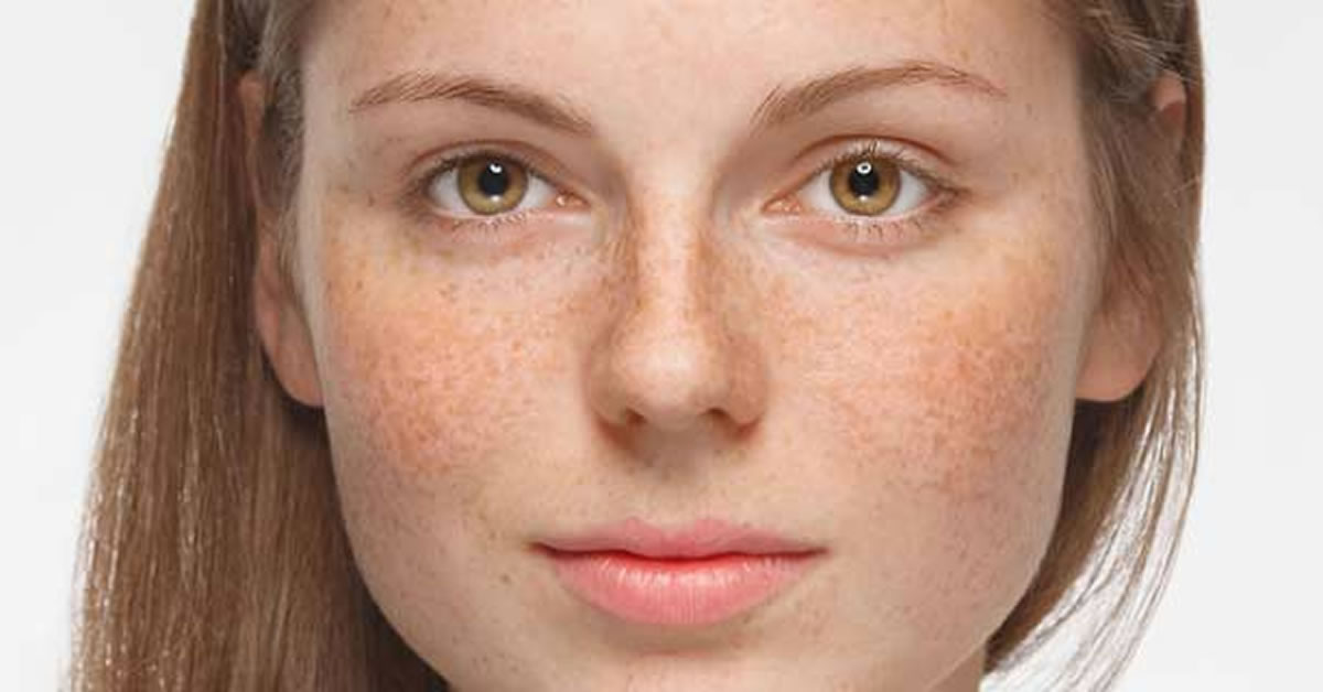 Skin condition scaly facial skin