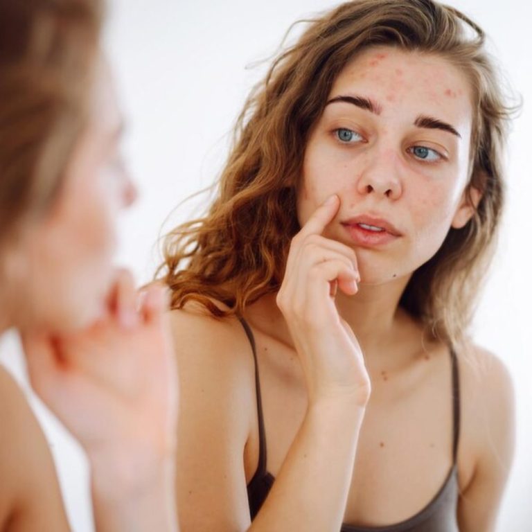 Жена с акне